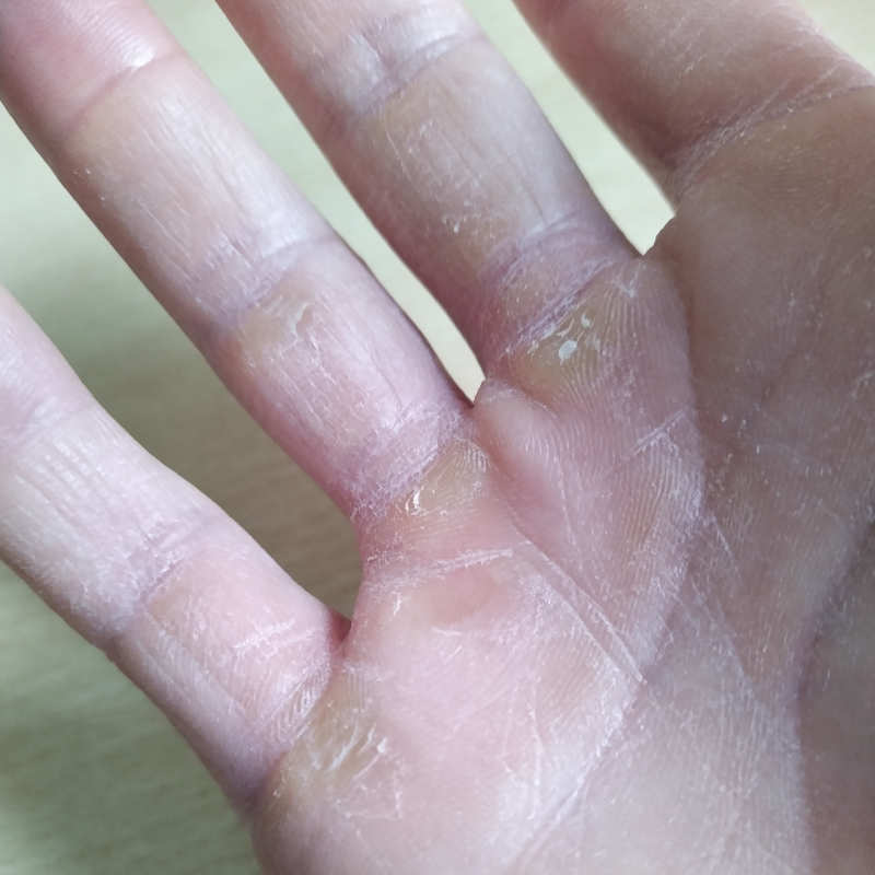 Calluses on hands from deadlifting heavy.