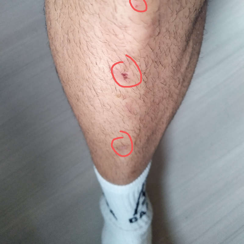 Close up of a shin of a man, with Healed skin wounds from deadlifting. The wounds are marked by a red circle.